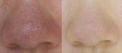激光收缩毛孔可以保持多久