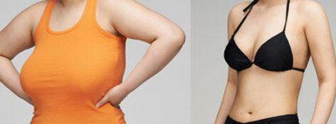 做巨大乳房缩小手术会有副作用吗