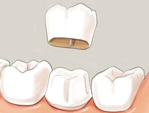 天津,华美,做烤瓷牙,大概,多少钱