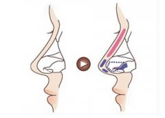 北京八大处做隆鼻果怎么样 多少钱 北京八大处做隆鼻果怎么样 多少钱