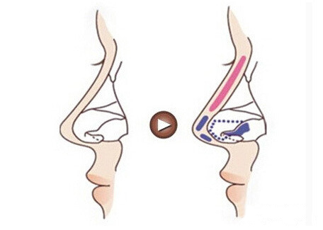 北京,八大处,做隆鼻,果,怎么样,多少钱