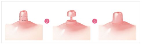 衡水,乳头缩短术,价格,大概是多少