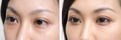 去除黑眼圈的手术要多少钱 去除黑眼圈的手术要多少钱