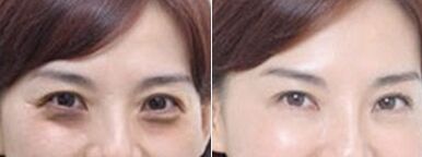激光去黑眼圈应该多久做一次