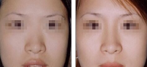 隆鼻假体能不能取出