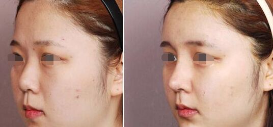 假体隆鼻后取出多久可以恢复