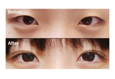 北京,韩式,三点双眼皮,手术,多少钱