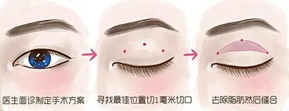 北京,韩式,微创双眼皮,手术,多少钱