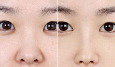 鼻头缩小术后几天能恢复