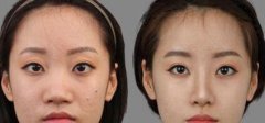 想要鼻头缩小有哪些方法