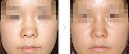鼻孔肥大用什么方法可以矫正