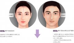 歪鼻矫正术后多久能恢复 歪鼻矫正术后多久能恢复