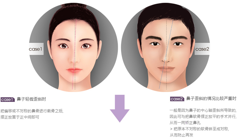 歪鼻,矫正,术后,多久,能恢复