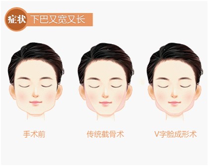 下颌角,整形后,多久,能化妆,术后,注意事项