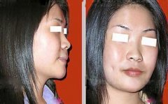 切开法酒窝成形术过程是怎样的