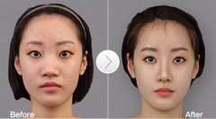 广州鼻头缩小整形术多少钱 广州鼻头缩小整形术多少钱