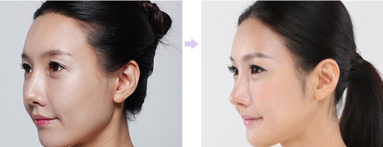 广州,鼻头,修复,整形,多少钱