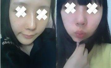 广州,鼻部,整形,磨骨,多少钱