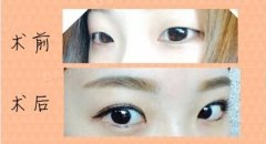 双眼皮手术后多久消肿