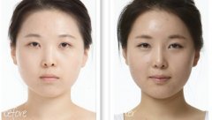 假体隆鼻后多久可以恢复