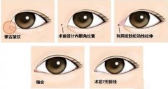 天津内眦赘皮矫正术多少钱