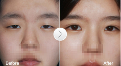 双眼皮消肿需要多久