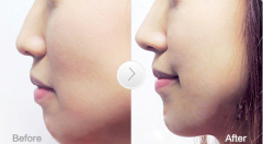 海南边防皮肤病医院假体隆鼻多少钱 海南边防皮肤病医院假体隆鼻多少钱