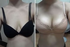假体丰胸能摸出来吗