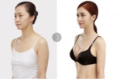 假体隆胸果怎么样 假体隆胸对人体有危害吗