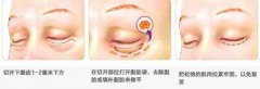 上海眼睑肿物切除术多少钱