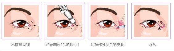 上海,睑退缩,矫正术,多少钱