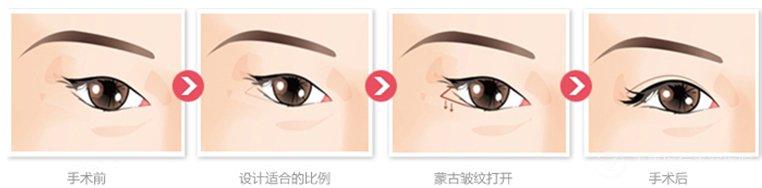 榆林,眼角,提升术,多少钱