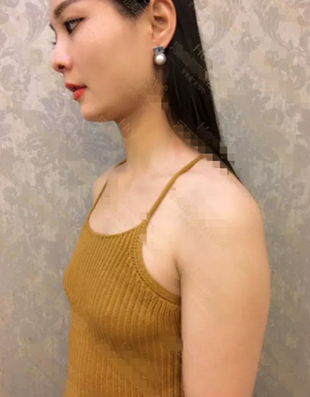 妙桃琴面假体隆胸手术恢复过程及真实效果照片分享