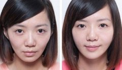 自体脂肪填充面部价格多少钱