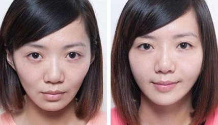 自体,脂肪,填充,面部,价格,多少钱