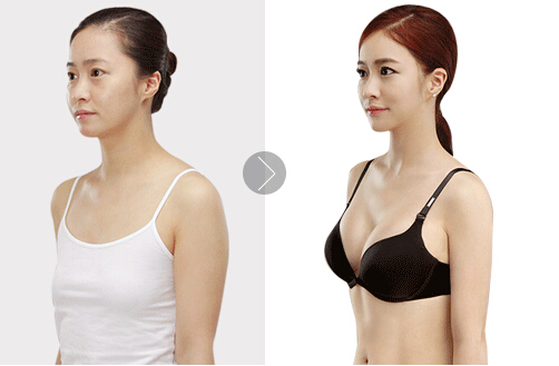 自体,脂肪,丰胸,会不会,影响,哺乳,果,逼真吗