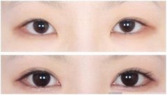 每个人都适合开眼角吗 每个人都适合开眼角吗