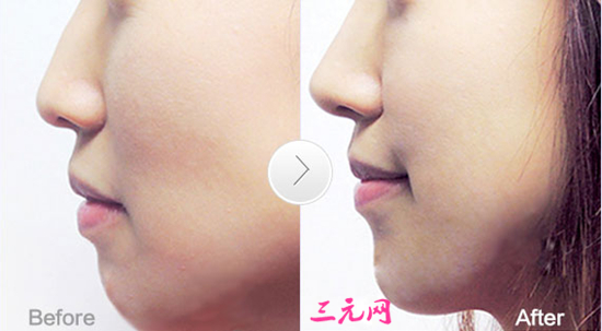 注射,玻尿酸,隆鼻,之后,会肿胀吗