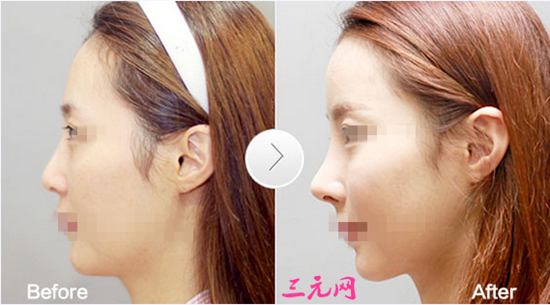 冬天,可不可以,做双眼皮,手术,优势,有哪些