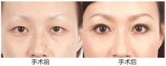什么是芭比眼双眼皮?术后多久恢复?