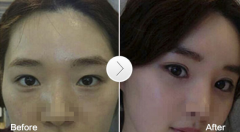 双眼皮割的太宽该怎么修复呢