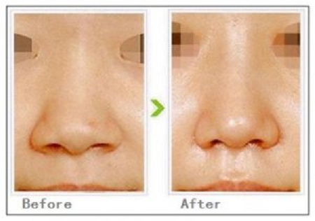 鼻孔缩小手术适应人群,方法和对比图