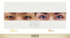 天津伊美尔芭比平行双眼皮多少钱