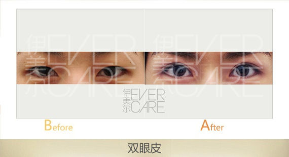 天津,芭比,平行,双眼皮,多少钱