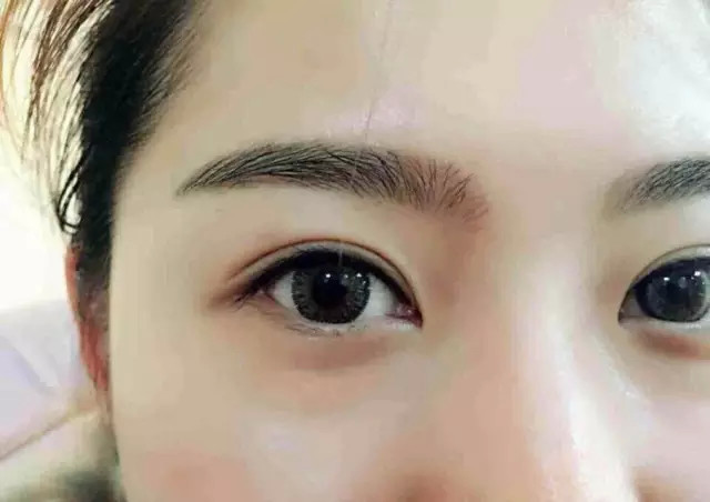 双眼皮和美瞳线一起做 让你拥有勾魂媚眼