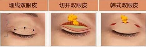 【南充新韵整形双眼皮开眼角价格表】