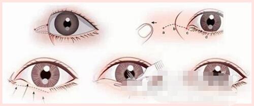 【南充新韵整形双眼皮开眼角价格表】