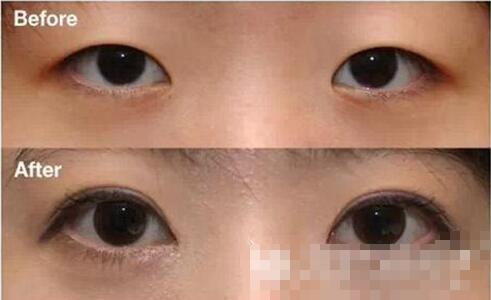 【南充新韵整形双眼皮开眼角价格表】