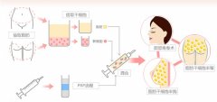 重庆天妃自体脂肪隆胸果怎么样？多少钱？