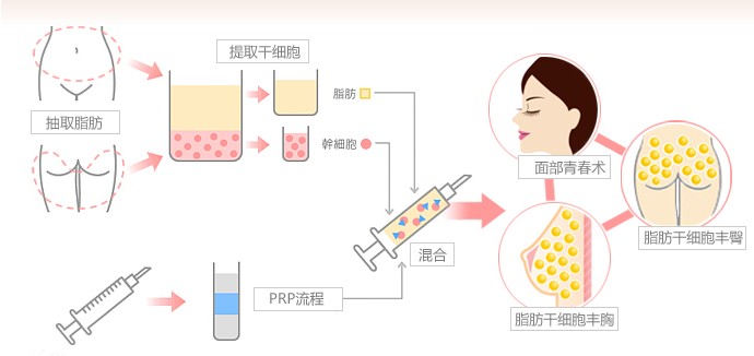 重庆,天妃,自体脂肪,隆胸,果,怎么样,多少钱